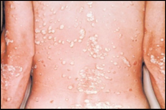 Pustular Skin Disorders | SpringerLink
