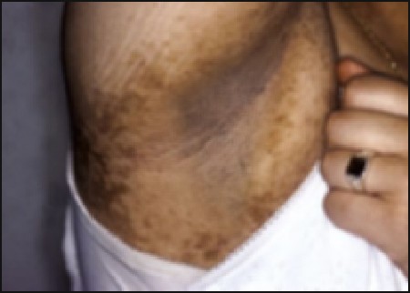 Acanthosis Nigricans Associated with Insulin Resistance | SpringerLink