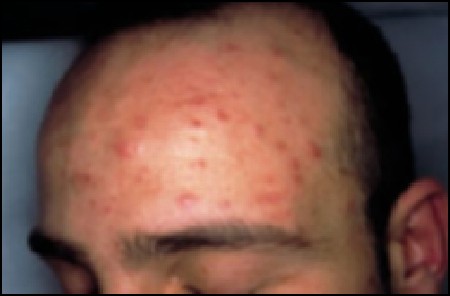 Perioral Dermatitis? Gram Negative Folliculitis? Tinea Barbae? What is  this? : r/Folliculitis