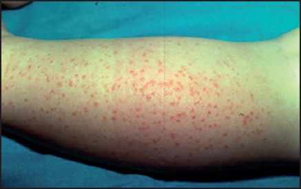 Mucocutaneous Manifestations Of Epstein Barr Virus Infection Springerlink