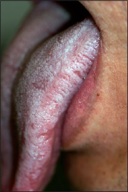 Mucocutaneous Manifestations - Warts-types-Diagnosis-Treatment Options-Best Treatment | Homeopathic | Best Homeopathic Doctor in Pakistan | Dr Qaisar Ahmed MD, DHMS