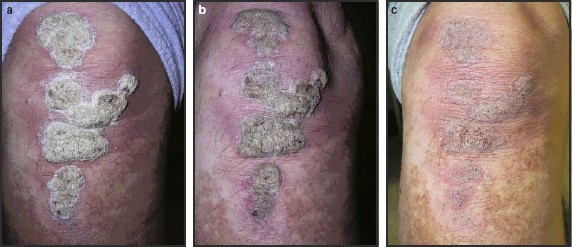 clobetasol psoriasis reviews