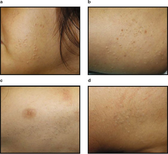 Eruptive Vellus Hair Cysts | SpringerLink Eruptive Vellus Hair Cysts | SpringerLink