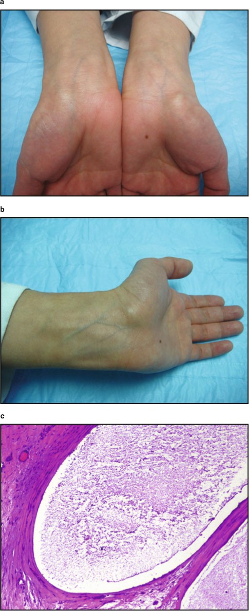 pic Wrist Bilateral Piezogenic Papules Of The Heel orthopedic pathologies