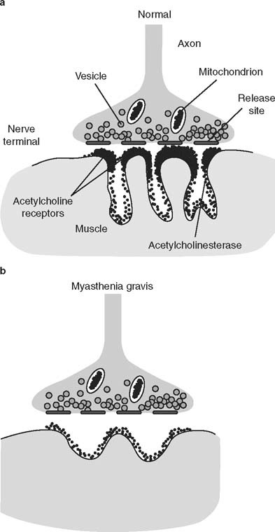 Treat Myasthenia Gravis With Individualized Doses Of Acetylcholinesterase Inhibitors And Immunomodulators Springerlink