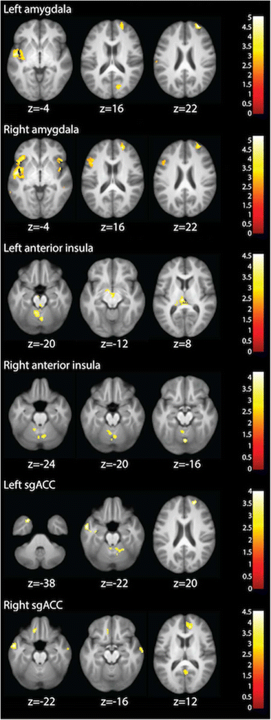 Integrated Cross Network Connectivity Of Amygdala Insula And Subgenual Cingulate Associated With Facial Emotion Perception In Healthy Controls And Remitted Major Depressive Disorder Springerlink
