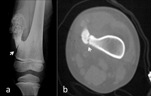 Osteocondroza dă în articulații - Artroza posttraumatică a semnelor gleznei