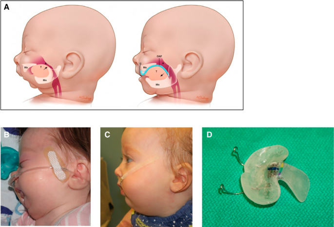 Plate Obstructer Nonsurgical improvement of severe upper airway obstruction in infants ...