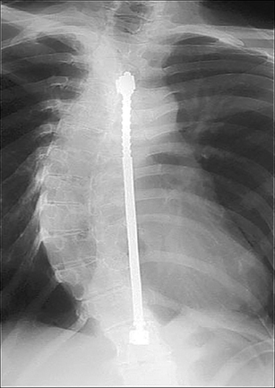 Pediatric spine imaging post scoliosis surgery | Pediatric Radiology ...