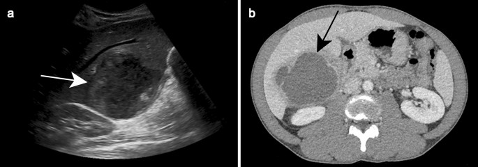 Liver abscess pdf image
