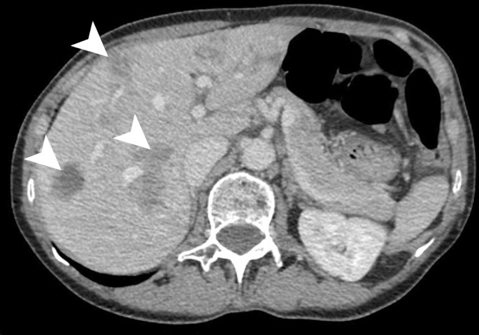 Liver abscess thesis picture
