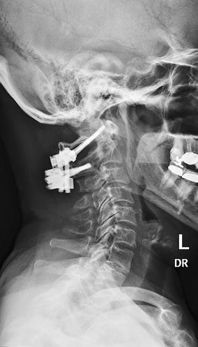 What makes spondylolisthesis worse picture