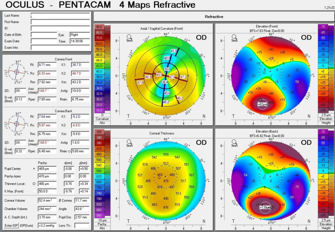 pellucid corneal degeneration pellucid corneal degeneration