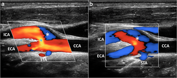 High-frame rate vector flow imaging of the carotid bifurcation ...