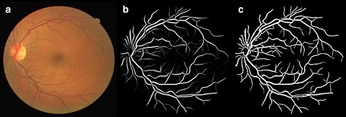 Retinal blood vessel segmentation biology essay 06 image