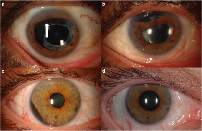 Uveal melanoma relatively rare but deadly cancer Eye