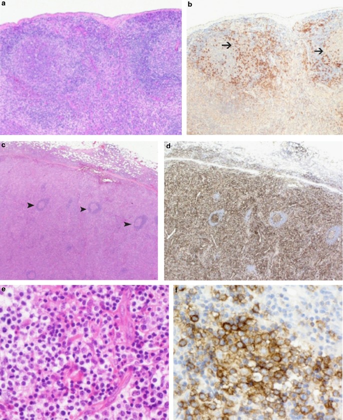 Angioimmunoblastic T-cell lymphoma with hyperplastic ...