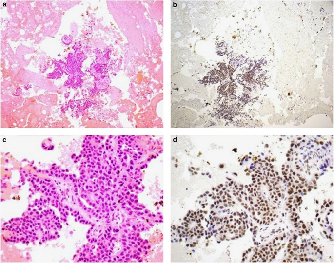 Loss of expression of BAP1 is a useful adjunct, which ...