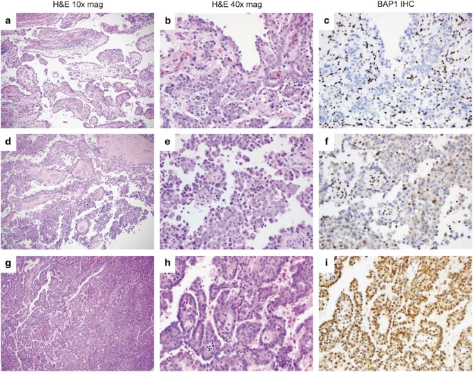 Genomic profiling of malignant peritoneal mesothelioma ...