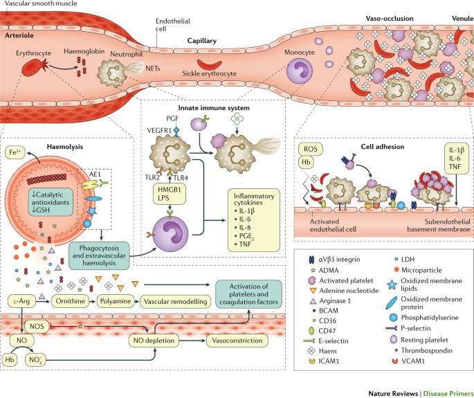 Sickle cell disease Nature Reviews Disease Primers
