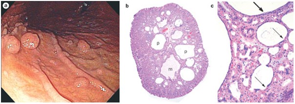 Management of gastric polyps: a pathology-based guide for ...
