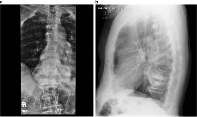 Pseudarthrosis l5-s1 icd 10 picture
