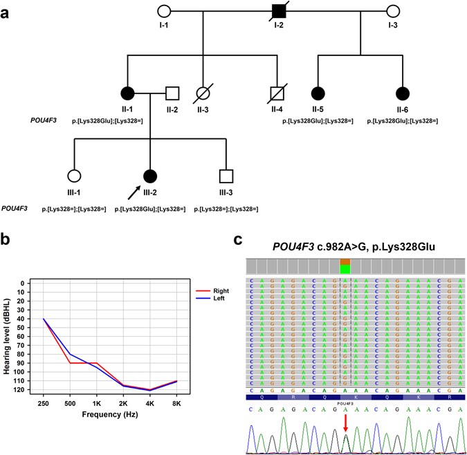 A novel missense variant in the nuclear localization signal of POU4F3 ...