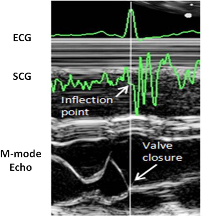 An algorithm for the beattobeat assessment of cardiac mechanics