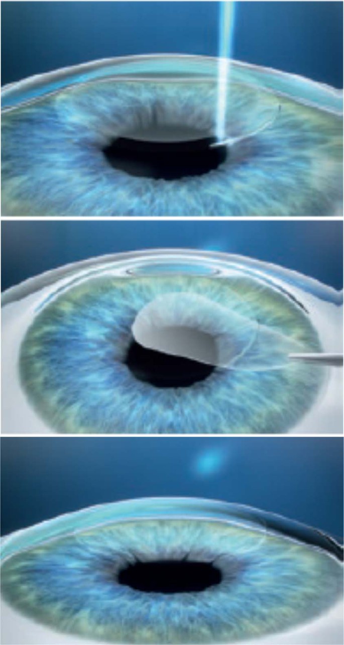 Small incision lenticule extraction