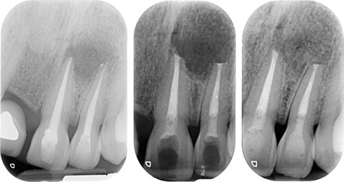 periradicular surgery endodontic lesions oral carried respond fail removal technical treatment