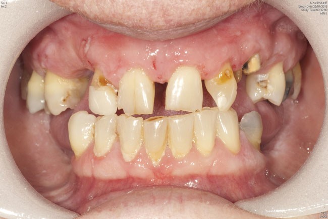 Do It Yourself Veneers / Veneers Brookline Ma Boston Ma Porcelain Veneers Whiteman Dental ...