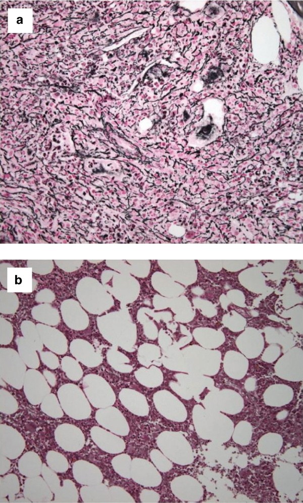Longterm remission of myelofibrosis following