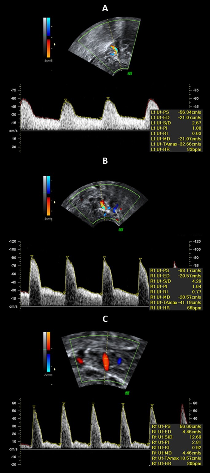 Uterine artery impedance during the first eight postpartum weeks ...