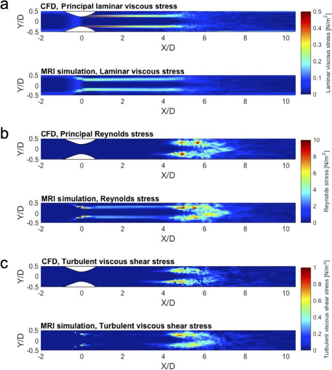 Assessment of turbulent viscous stress using ICOSA 4D Flow MRI for