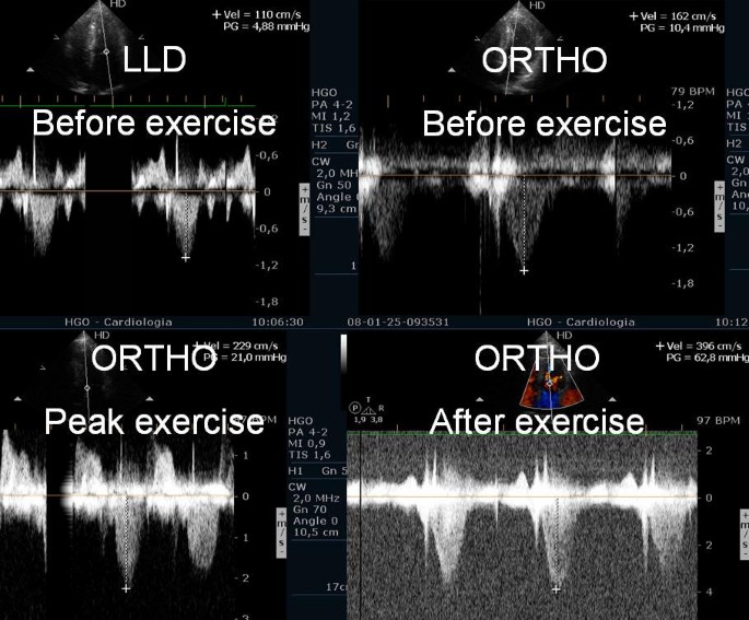 Evaluation of left ventricular outflow tract gradient during treadmill ...