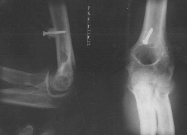 Steindler flexorplasty to restore elbow flexion in C5-C6-C7 brachial