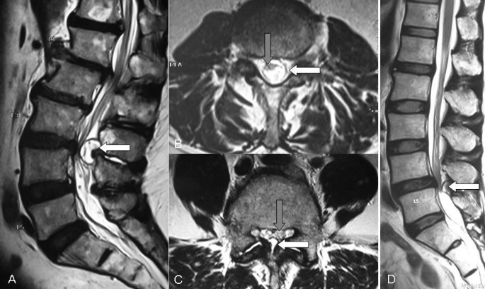 Rare ligamentum flavum cyst causing incapacitating lumbar ...