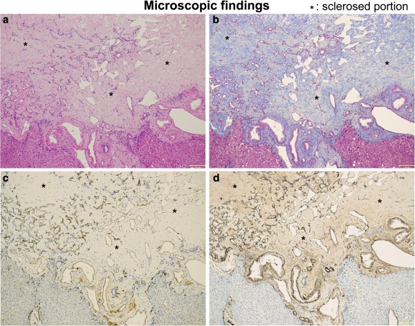 A hepatic sclerosed hemangioma with significant morphological change ...