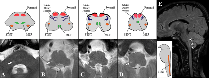 Isolated optic neuritis with a concurrent abnormal trigeminal nucleus on imaging: case report of ...