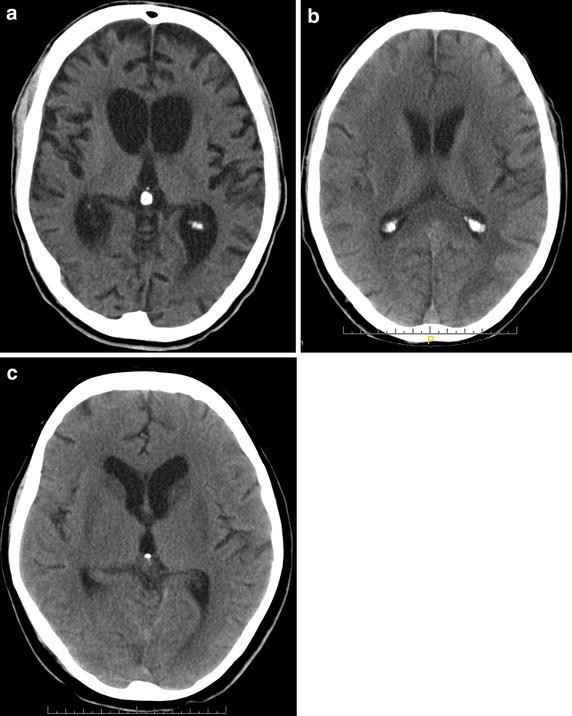 Outcome and prognosis of hypoxic brain damage patients ...