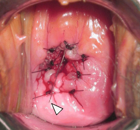 Levonorgestrel-releasing intrauterine system placement for ...