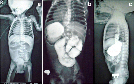 How rare is situs inversus with dextrocardia picture
