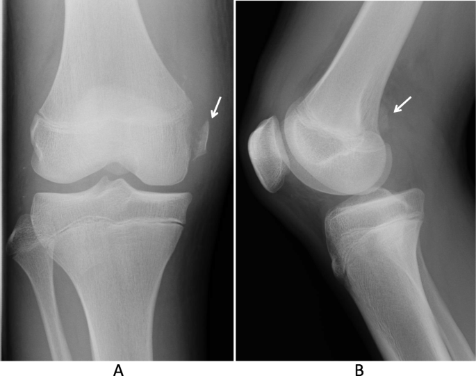 Avulsion fracture of the medial head of the gastrocnemius