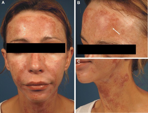 Dangers of Skin Whitening