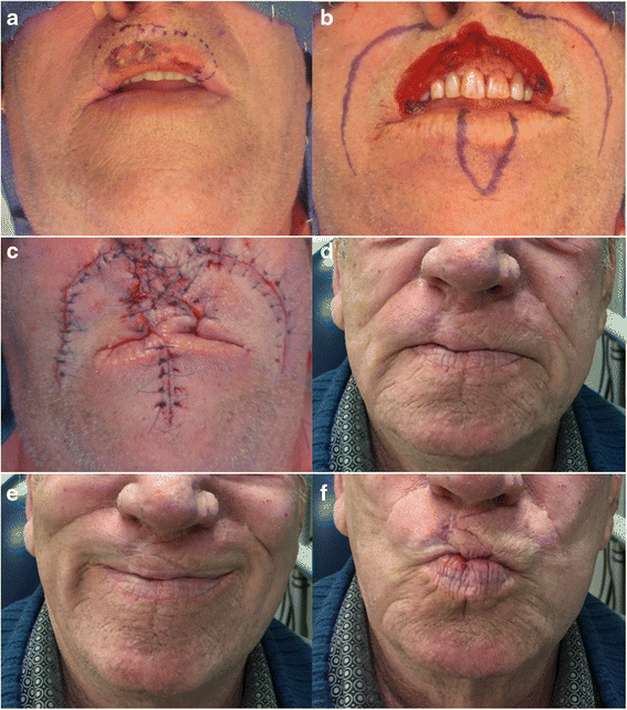 The use of a modified abbé island flap to reconstruct ...