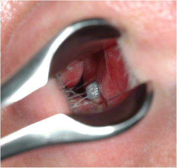 Altered nasal airflow: an unusual complication following ...