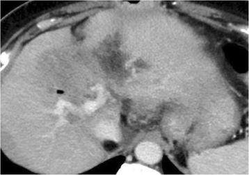 relapse treated after tumor liver tomography computed intrahepatic bile neither duct dilatation years