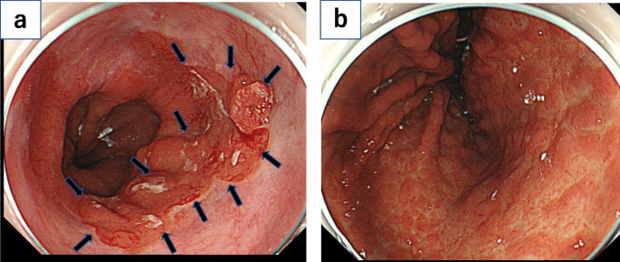 A case of Barrett’s esophageal cancer with gastric mucosa