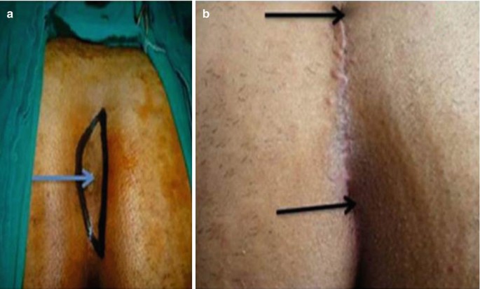 a, b, c. A. Marking of the incision containing the pilonidal cyst and 2
