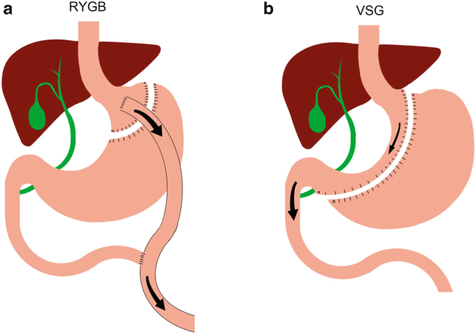 Esophagus-duodenum Gastric Bypass Surgery Improves Glucose and Lipid  Metabolism in Mice - eBioMedicine
